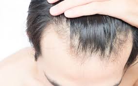 Gerade im frühjahr oder herbst verlieren einige menschen mehr haare: Geheimratsecken Mit 20 Jahren Welche Behandlung Ist Effektiv Elithair