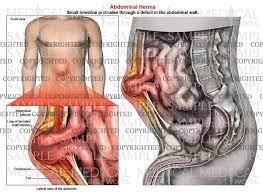 The female muscular system laminated anatomical chart. Abdominal Hernia Anatomy Of Male Medical Art Works