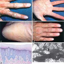 Expanding The Phenotypic Spectrum Of Cx26 Disorders Bart Pumphrey Syndrome Is Caused By A Novel Missense Mutation In Gjb2 Sciencedirect