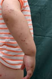 Generally speaking, spots are four to 10 millimeters in diameter—like a pinpoint—and cluster in a concentrated area. Henoch Schonlein Purpura