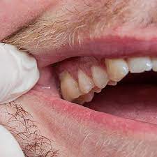 Watch For These 4 Signs Of Gum Disease John L Hyatt Dds Ms Pa