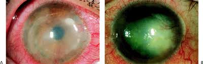 Clinical features that should be evaluated include the status of the epithelium and the location and type of stromal inflammation. 1 External Diseases The Wills Eye Hospital Atlas Of Clinical Ophthalmology