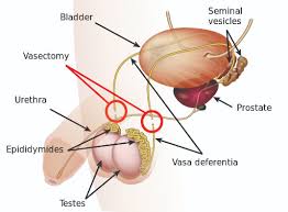 A vasectomy is a reliable form of birth control that helps prevent unplanned pregnancy. Vasectomy Men S Sexual Health Tennessee Urology