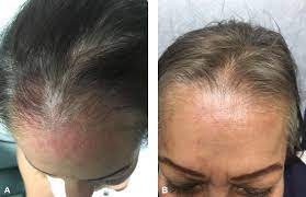Lymphoma is one of the most common causes of death from cancer in the united states. Rare Presentation Of Disseminated Follicular Lymphoma As An Ill Defined Reticular Patch Over The Scalp And Forehead Jaad Case Reports