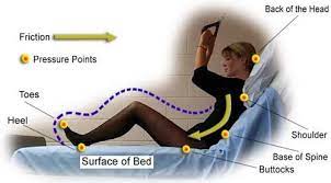 Pressure Ulcers Myvmc Pressure Soreness Pressure Ulcer