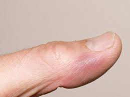 <blutergusses, blutergüsse> der bluterguss subst hämatom eine stelle, an der sich z. Achenbach Syndrom Ursachen Symptome Behandlung Medlexi De