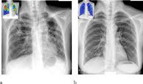 At the description of these shadows it is. Computer Aided Detection Of Tuberculosis On Chest Radiographs An Evaluation Of The Cad4tb V6 System Scientific Reports