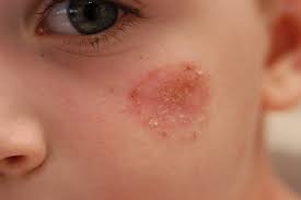 Image result for Impetigo