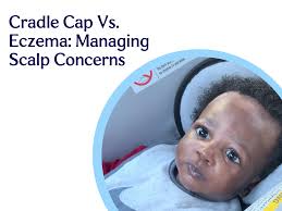 Image result for Cradle Cap