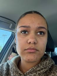 Diagnosed with pcos recently with explains my acne problems. If I don't  have make up