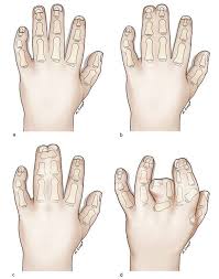 Richard stott was diagnosed with poland syndrome at birth, which meant his left hand was underdeveloped with short, webbed fingers, rendering it useless. Treatment Of Congenital Syndactyly Of The Fingers Tidsskrift For Den Norske Legeforening