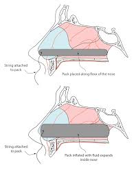 Image result for Nasal Packing