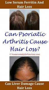 Hairmax Lasercomb Hair Loss Forum Hair Loss Does Lack Of Iron Cause Hair Loss Hair Loss Stages O Hair Loss Remedies Women Vitamins For Hair Loss Help Hair Loss