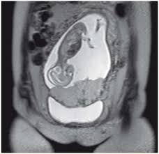 Une syphilis maternelle non traitée entraîne soit la mort in utero (40%), soit une syphilis congénitale (40. Risques A Long Terme De L Accouchement Par Cesarienne