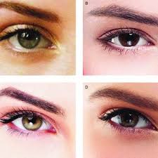 Most people return to their daily routines immediately afterward. Pdf Identifying Aesthetically Appealing Upper Eyelid Topographic Proportions