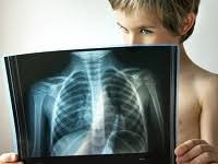Pnevmoniya U Detej Prichiny Simptomy Diagnostika I Lechenie Pnevmonii U Rebenka V Moskve V Detskoj Klinike Sm Doktor