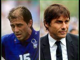 Antonio conte tak ingin ada kejutan yang merugikan nerazzurri. Antonio Conte Chelsea Fc Coach 3 Hair Transplants Youtube