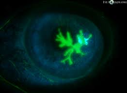 Check spelling or type a new query. Herpes Simplex Virus Hsv Geographic Epithelial Keratitis