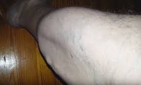The birds are chirping outside already. Video Shows Man S Calf Rippling And Twitching As If Ants Are Underneath His Skin Daily Mail Online