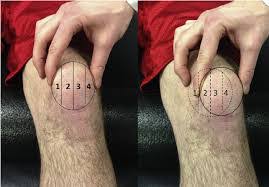 Image result for Patellar Apprehension Test