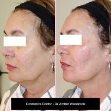 How to slim your facelifting saggy jowlsif you are interested in lifting saggy jowls and how to slim your face, my video on lifting sagging jowls may be of i. Saggy Jowls In Norwich Norfolk By Thecosmetics Doctor