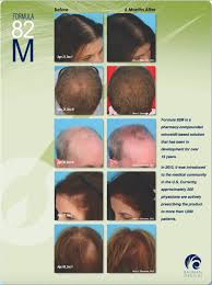 Yes, rogaine, with the fda approved minoxidil works well to reduce hair fall as well as promotes new hair growth. Compounded Minoxidil Formula 82m Bauman Medical