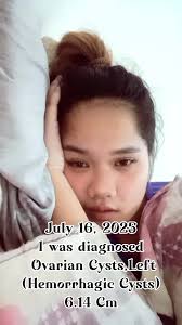 Sign Ng Ovarian Cyst