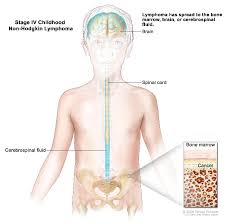Lymphoma develops when lymphocytes grow and multiply abnormally. Childhood Non Hodgkin Lymphoma Treatment Pdq