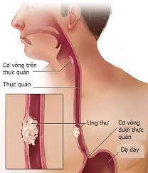 Khi khối u phát triển lớn hơn, biểu hiện cũng sẽ rõ ràng hơn. Cac Giai Ä'oáº¡n Cá»§a Ung ThÆ° Thanh Quáº£n