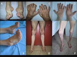 Vous pouvez également ressentir une perte de sensation et des contractions musculaires et. Turns Out Charcot Marie Tooth Disease Has Nothing To Do With Teeth That Was One Of The Discovering Doctors Nam Teeth Diseases Disability Awareness Awareness