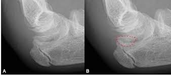 Recent studies have revealed limitations of some classically described evaluation methods. Intra Articular Displacement Of An Avulsed Medial Internal Epicondyle Ossification Centre In The Paediatric Elbow A Radiographic Finding Not To Be Missed Bmj Case Reports