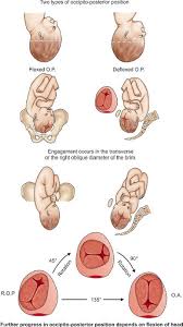 Image result for Manual Rotation in Occipitoposterior Presentation