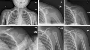 Image result for Shoulder Dislocation