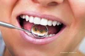 Unsichtbare Zahnspangen Invisalign Vs Incognito Kosten Vor Nachteile