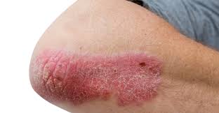 'psoriases' is a 9 letter word starting with p and ending with s. Psoriasis