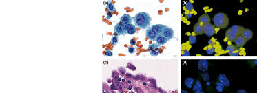 We did not find results for: Example Of A P16 Deletion Negative Malignant Pleural Mesothelioma Download Scientific Diagram