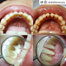 Pin By Wi Yim On Dent Note In 2020 Dentistry Dentist Dental Hygiene School