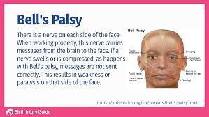 Bell's palsy is a peripheral nerve effect whereas a ischemic stroke is a central process. Infant Bell S Palsy Facial Paralysis