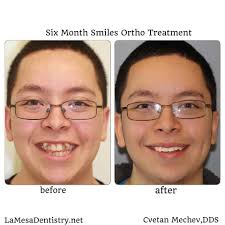 Six Month Smiles La Mesa 91942