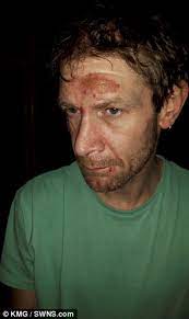 Victim May Never See Again After Acid Squirted In Face Daily Mail Online