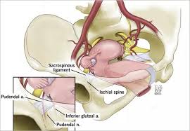 Image result for Rectal prolapse