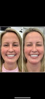 Power of veeners 2 years follow up amazing gingival condition all clinical  work done by me Design and ceramic work done by Dr Amira Said