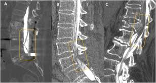 Image result for Low Back Imaging