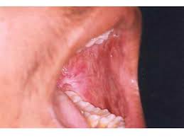 Image result for Labial mucosa