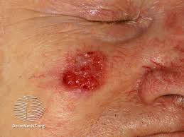 In this episode we describe carcinomas and carcinoma types. Skin Cancer Image Gallery Pictures And Photos