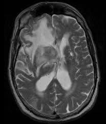 Image result for Brain Lesion