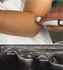 Image result for Elbow Joint Injection