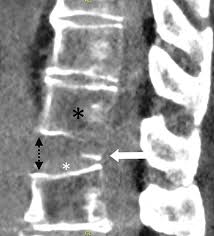 Image result for Chance Fracture