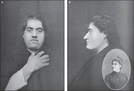 Image result for Acromegaly