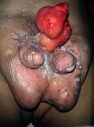 Diphallie Wikipedia